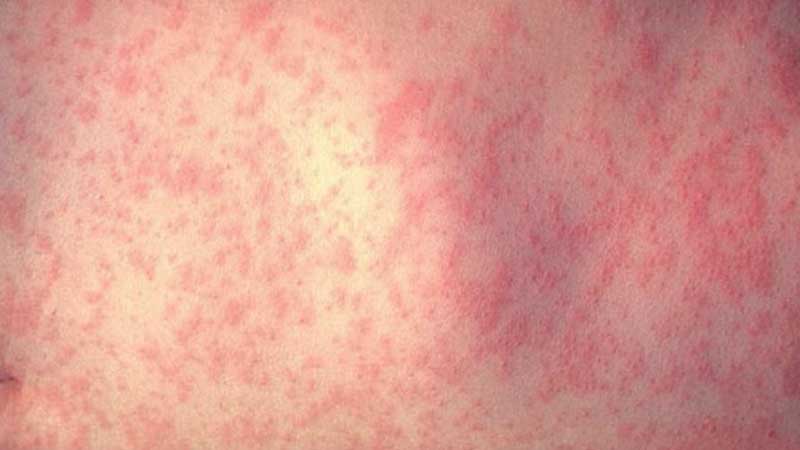 ⚠️⚕️🍁🏙️ Toronto Public Health Advising of Potential Measles Exposure at Major Tourist Attraction